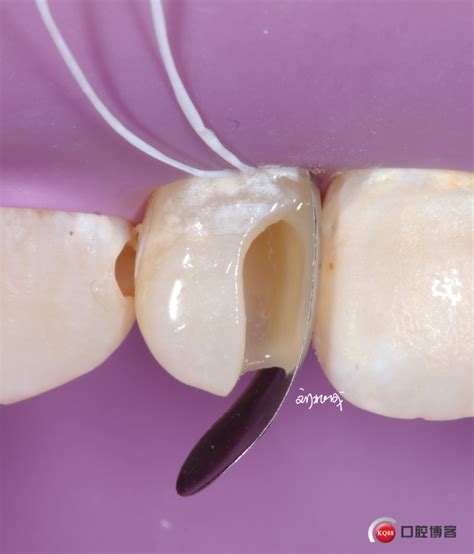 14岁小女孩前牙根管治疗后树脂美学修复-刘兆成的博客-KQ88口腔博客