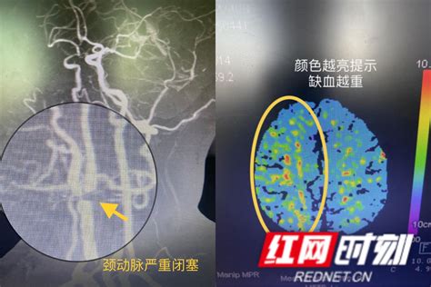 脑浆图片