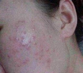皮肤过敏原因有哪些_经常过敏是什么原因_青岛皮肤病研究院