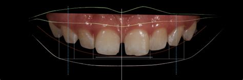 从专注细节到追求极致：以修复为导向的前牙美学种植案例 - 知乎