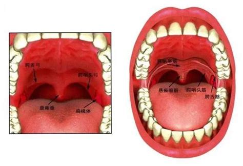 腭咽弓发炎图片
