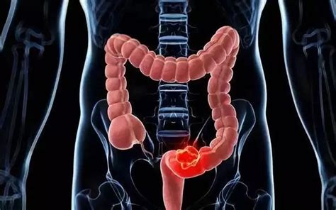慢病界-胃肠道疾病种类多，如何区分？这五类易癌变，需警惕！