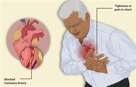 你知道心梗的表现症状有哪些吗，带你了解心梗症状_凤凰网视频_凤凰网