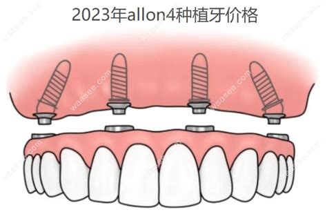 2023年allon4种植牙价格,全口价格12w+/半口价格7w+ - 口腔资讯 - 牙齿矫正网