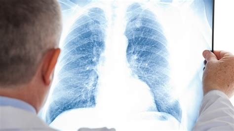什么是肺癌的早期筛查?可以做这三个检查-肺癌检查-复禾健康