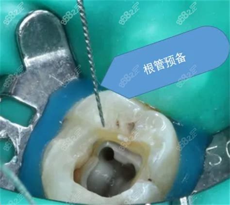 根管治疗收费标准明细:解答做一颗根管治疗全套收费明细 - 口腔资讯 - 牙齿矫正网