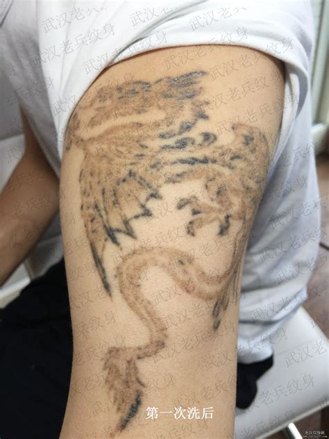 小哥大臂龙纹身图案皮秒洗纹身第五次效果案例比对 - 皮秒激光洗纹身案例 武汉老兵纹身