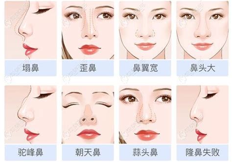 【图】中国人的鼻子类型 对比一下你属于哪种_鼻子_伊秀美体网|yxlady.com
