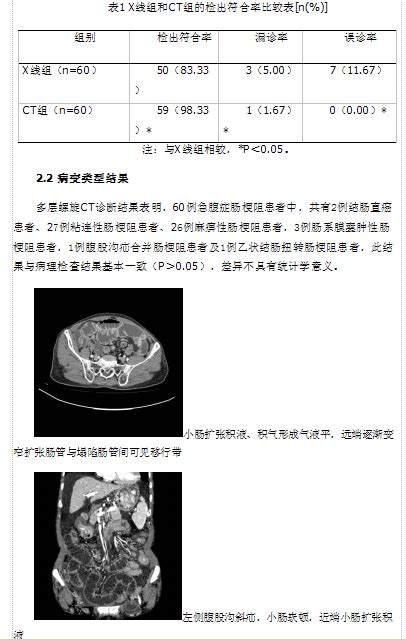 多层螺旋CT在急腹症肠梗阻的诊断价值观察--中国期刊网