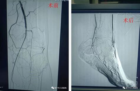 “腿梗”怎么办？我院成功完成下肢动脉血管内机械血栓清除术-常宁市人民医院官网