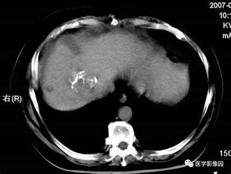肝癌肝动脉化疗栓塞（TACE）前后影像学比较