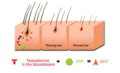 DHT : comment provoque-t-elle la chute de cheveux héréditaire? | Hair ...