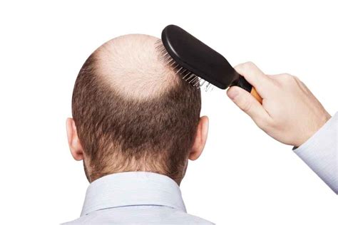 脱发类型有哪些？脱发如何治疗？ – 生发垂直网
