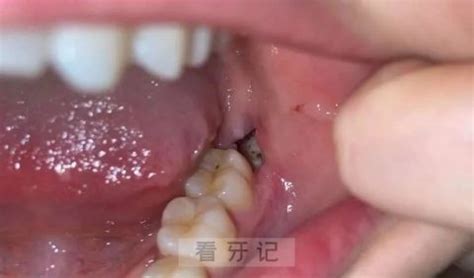 干槽症伤口图片
