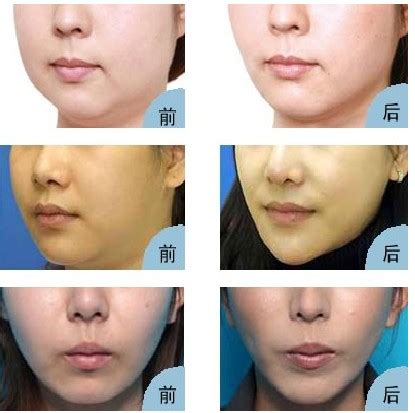 双下巴吸脂前后对比图整形案例 - 杭州格莱美医疗美容医院 - 炫美网
