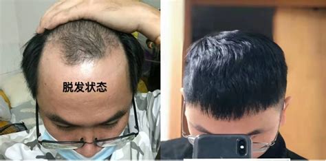 为什么植发效果相差半边天？广州青逸植发医院专家透入原因居然是……--常识