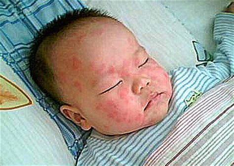 小儿慢性荨麻疹是什么原因图片_有来医生