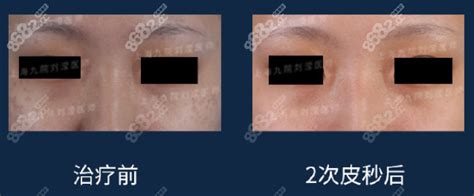[上海九院激光美容科]2次皮秒激光治疗颧部褐青色斑对比图,皮肤治疗对比照-8682赴韩整形网