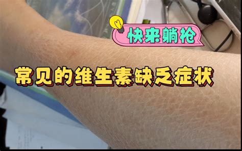 1分钟测出你缺什么维生素！_凤凰健康