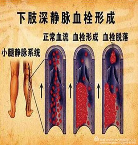 静脉血栓图片