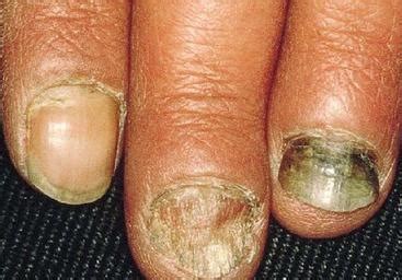 得了灰指甲，一个传染俩，这5种人最容易得灰指甲-北京安达医院