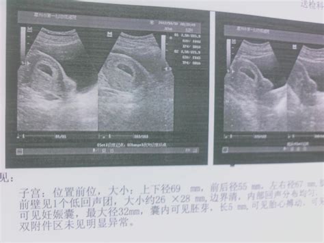 怀孕50天B超图显示如下，孕囊一般是三个数据，至少也两个，为何该医院只给出一个？ - 百度宝宝知道