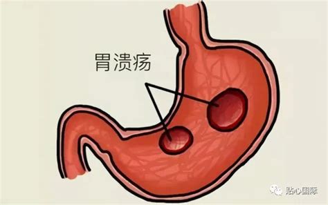 胃食管反流病为何难诊断？ - 孚维尔生物医疗