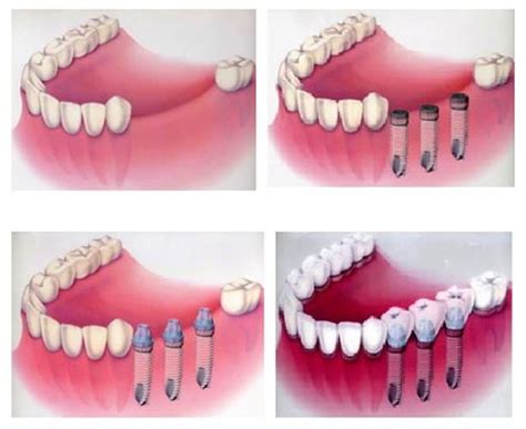 你清楚种植牙的过程是怎么的吗？ | 升艺口腔医院