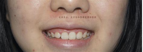 关于开唇露齿笑（gummy smile）及最简单的治疗方法 - 知乎