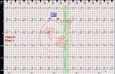 心电图图例分析：加速的房性逸搏心律、室性早搏、早期复极 - 爱爱医医学网