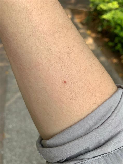 你们觉得哪个是被蚊子叮咬的？