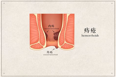痔疮什么样的图片
