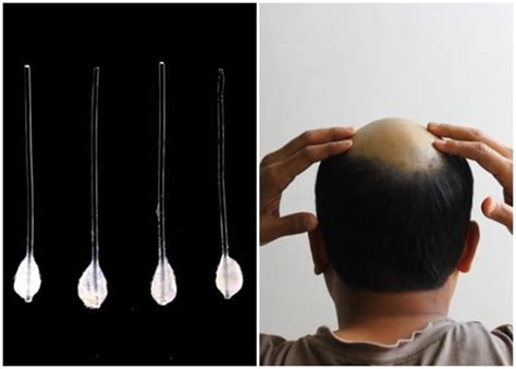 日本公司宣布成功研发出透过培养并移植毛囊细胞以大量生发的技术 - 神秘的地球 科学|自然|地理|探索