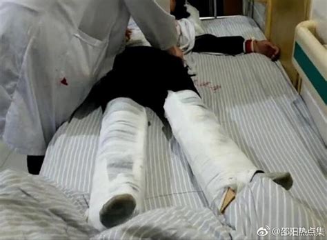 邵阳一初中女学生在校搞卫生，从二楼摔下造成双脚骨折