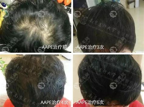 如何让头发再生的方法:南京友谊AAPE头发细胞再生疗法_南京医科大学友谊医院植发中心植发案例 - 毛毛网