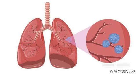肺部有肿瘤是不是恶性怎么查看_39健康网_保健