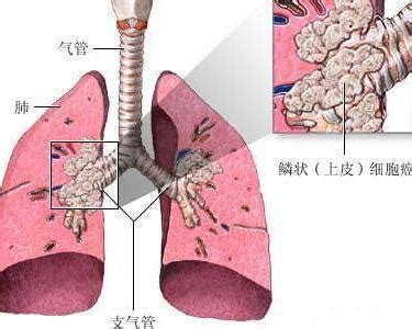 一分钟了解小细胞肺癌与非小细胞肺癌_凤凰网健康_凤凰网