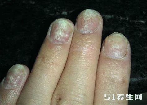 北京哪个医院治疗灰指甲比较好？ - 知乎