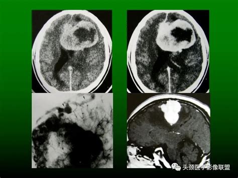 常见脑肿瘤的影像诊断 - 知乎