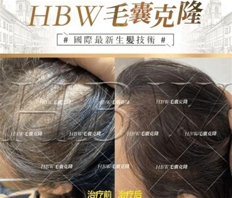 hbw毛囊克隆植发价格多钱?再说下HBW毛囊克隆技术的操作方式,毛发移植-8682赴韩整形网
