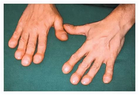 手指莫名出现杵状指，或是肺癌到来的信号，及时检查肺CT_患者