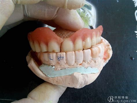 纯钛上颌全口义齿-吴柏康的博客-KQ88口腔博客