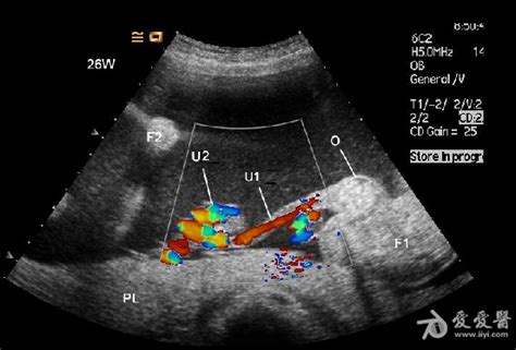胎儿发育的哪个阶段容易发生畸形？