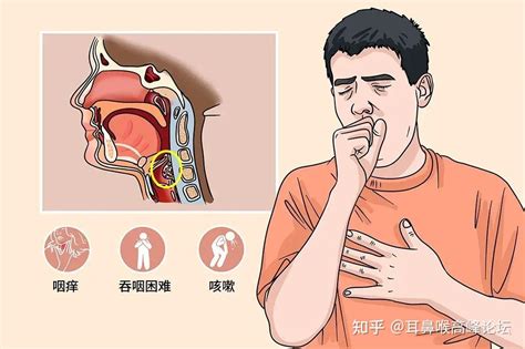 秋季咽痛、咽痒、干咳不断……专家提醒：咽喉炎不是小问题，一定要重视！ - 知乎