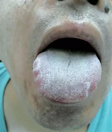 湿热舌苔图片