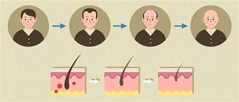 认识一下雄激素性脱发的临床分型分级-京东健康