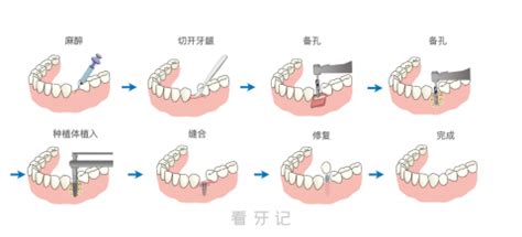 种植牙完整流程图最新版 - 看牙记网