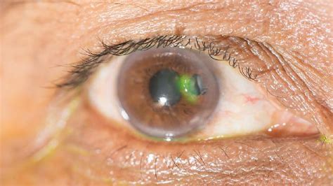 有老花眼还有白内障，怎么治疗？|治疗|手术|白内障|疾病|-健康界