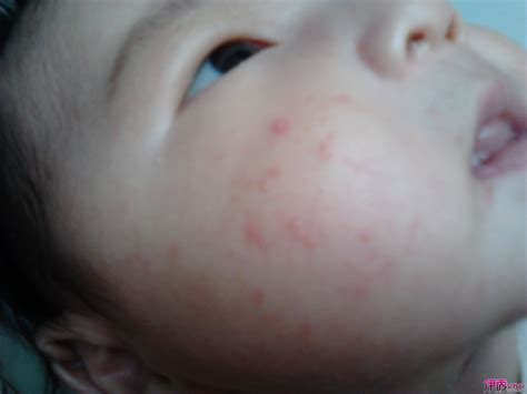 轻微婴儿湿疹的图片_有来医生