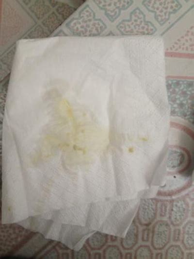 有炎症的白带图片